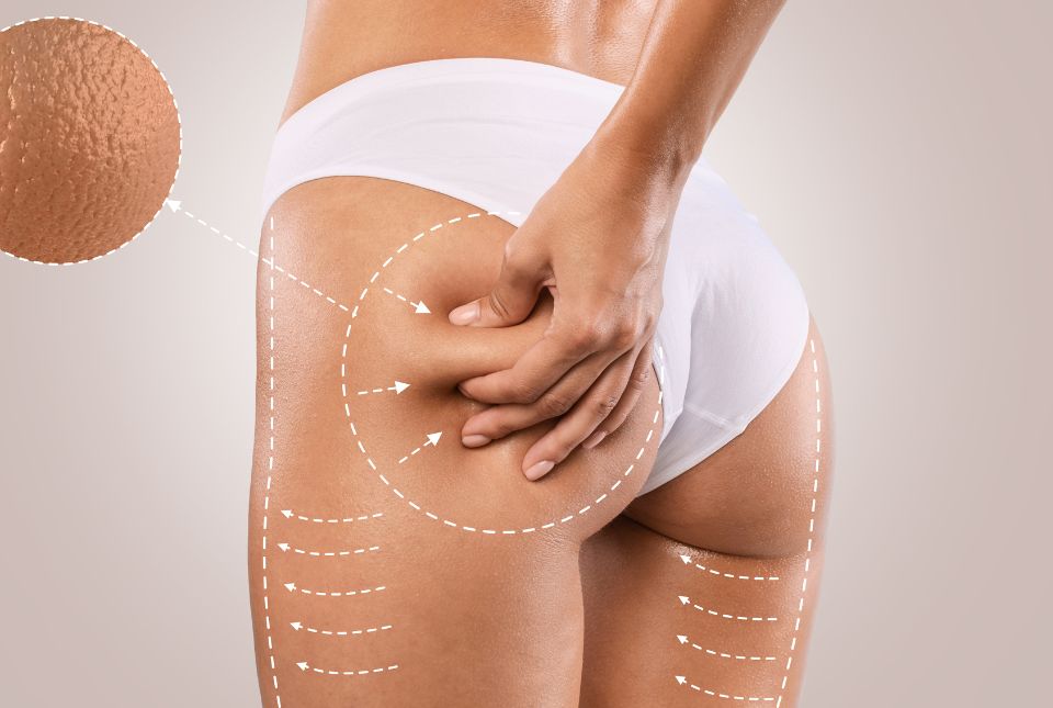 Combatir la Celulitis: Guía Práctica