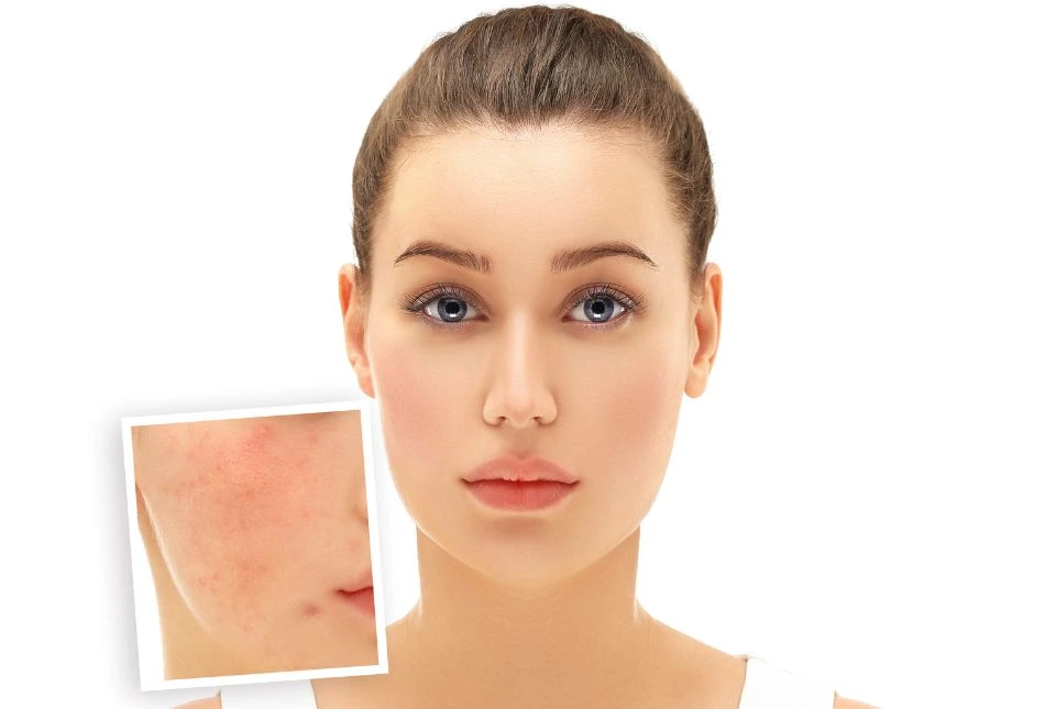 Rosácea y sensibilidad: Tu guía para una piel saludable